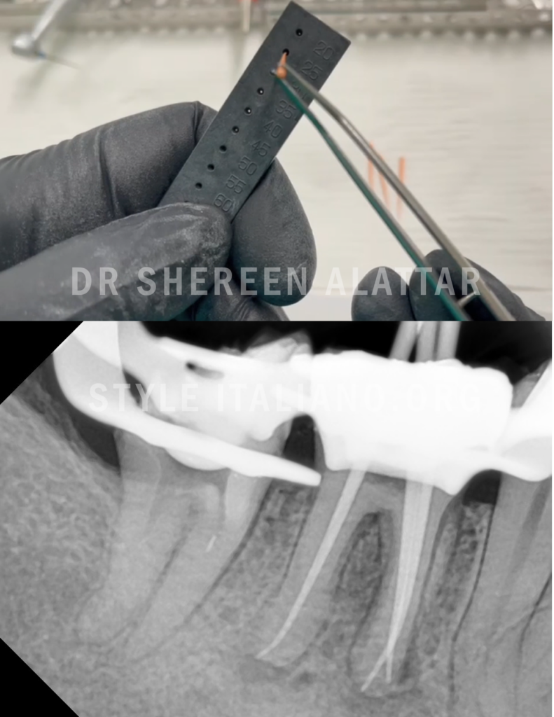 Image-for-meduim_Gutta_percha-with-radiograph-for-teeth