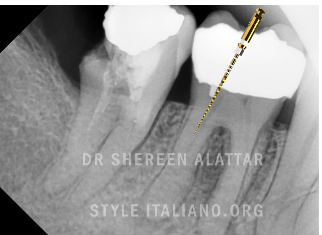 Image-for-show-injection-Shaper-file-with-radiograph-picture