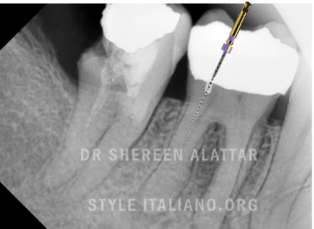 Image-for-show-injection-Slider-file-in-the-teeth