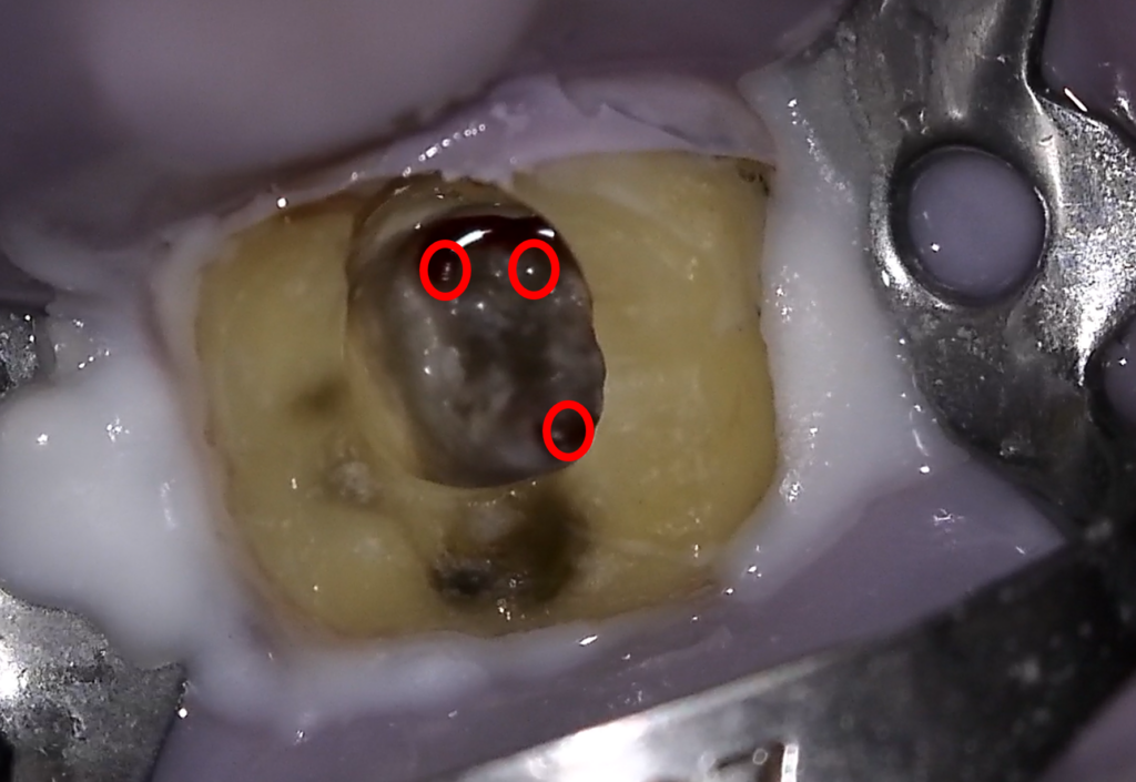 image-for-sufficient-visualization-to-show-the-pulp_stone-in-the-teeth