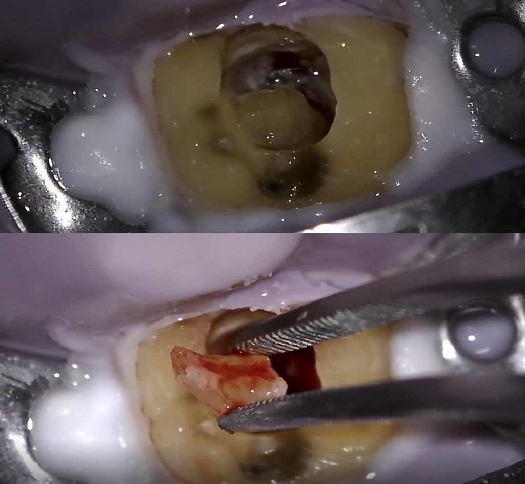 Two-Image-for-Removing-the-pulp-stone-from-the-teeth