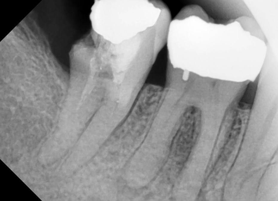 Radiograph-for-homogenous-radiopaque-contrast-within-the-pulp-chamber